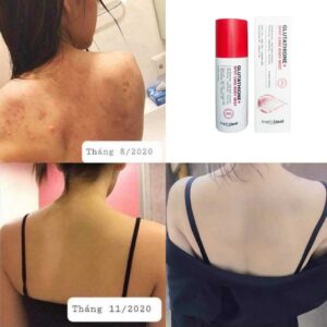 Xịt Trị Mụn Lưng, Trị Thâm Sau Mụn Ang...