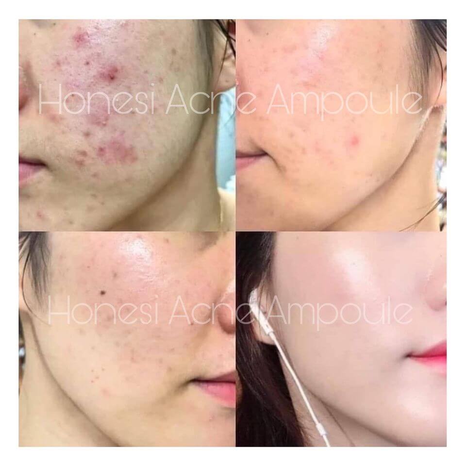 Công dụng của tinh chất cô đặc trị mụn Honesi