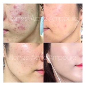 Tế Bào Gốc Trị Mụn Honesi Acne Treatment ...