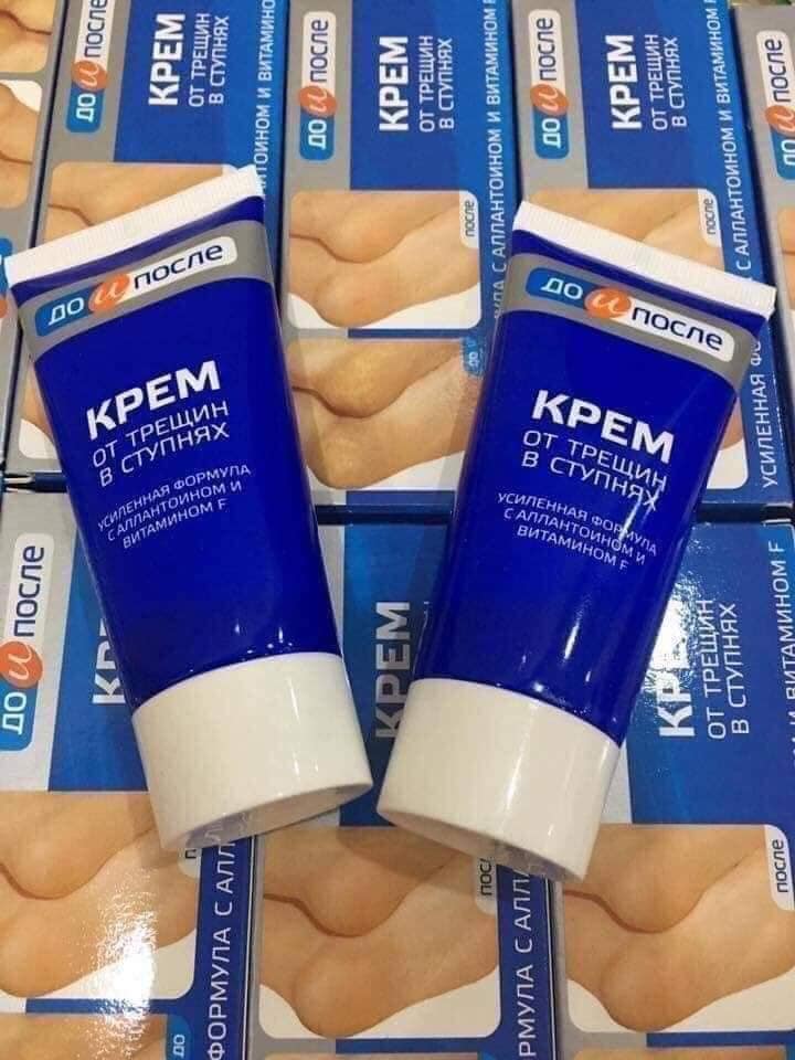 Kpem - kem trị nứt gót chân Nga có tốt không?