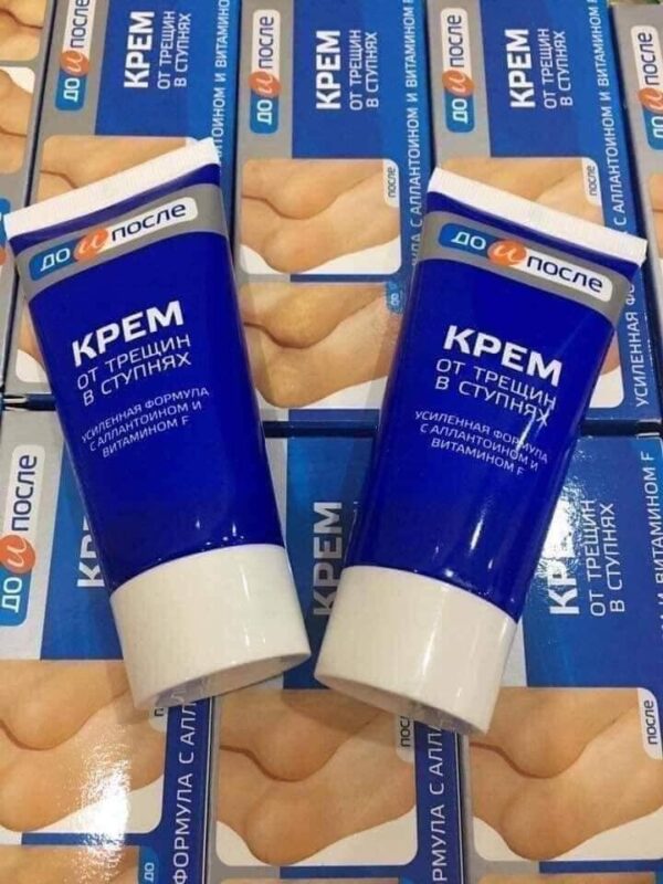Kem trị nứt gót chân Kpem của Nga