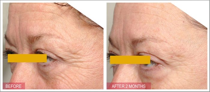 Hướng dẫn sử dụng serum chống lão hóa Timeless Matrixyl Synthe 6