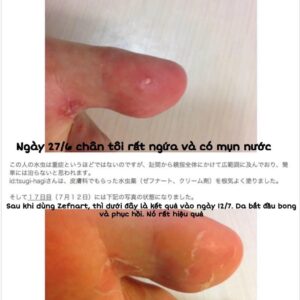 Kem hỗ trợ nấm da của Nhật ZEFNART 2% 10...