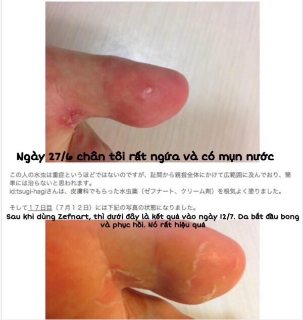 Kem hỗ trợ nấm da của Nhật ZEFNART 2% 10...