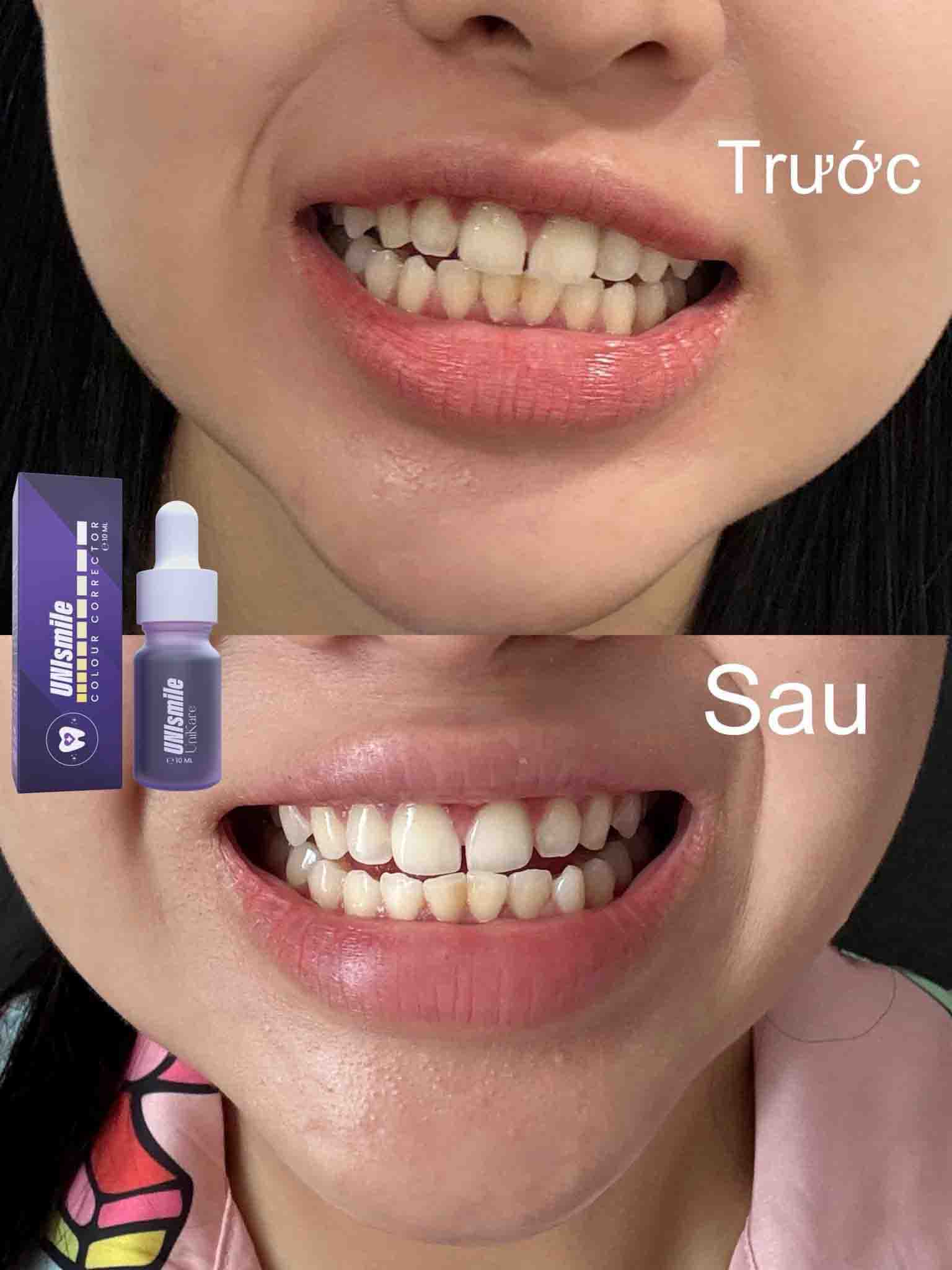 cách tẩy trắng răng ố vàng