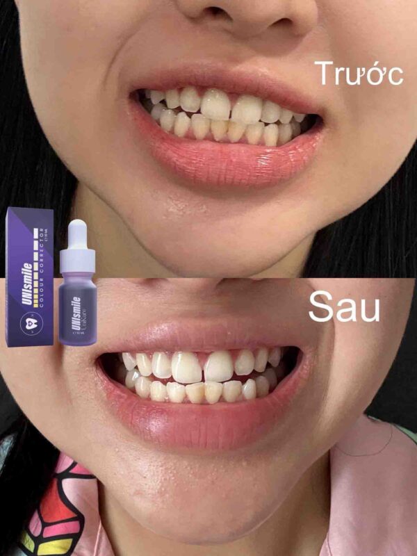 Serum Trắng Răng Unismile Hỗ Trợ Vết Ố ...