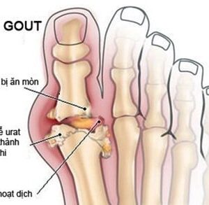 Viên uống The Goutto hỗ trợ Gout