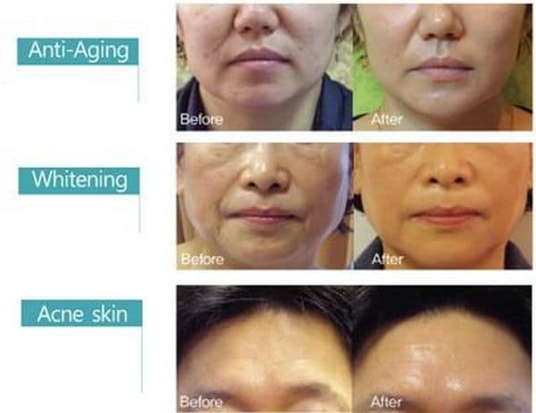 Thay da sinh học Matrigen B-Tox PeeL Hàn Quốc (2 màu, 4 màu) 6